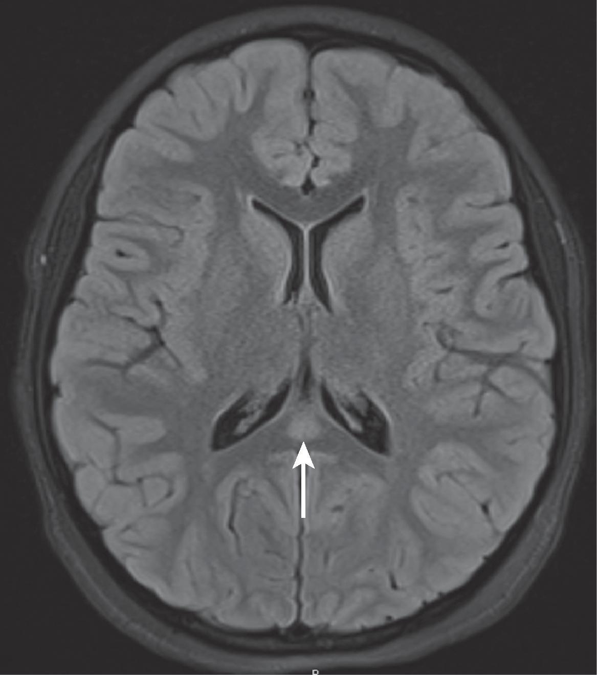 Transient Splenial Lesion