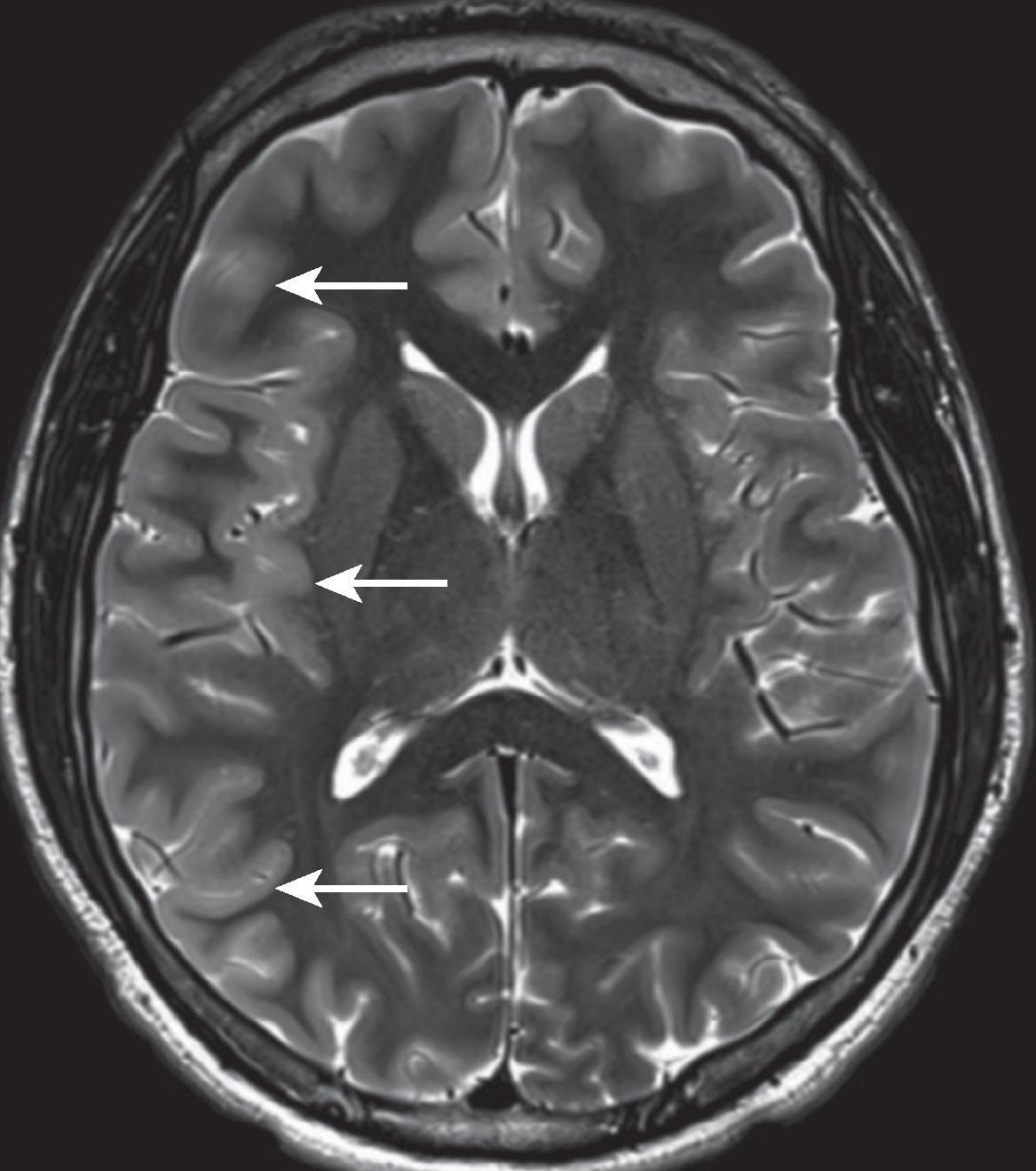 Cortical Edema