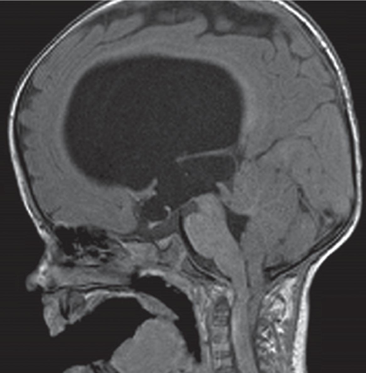 Chiari 1 and 2 Malformation