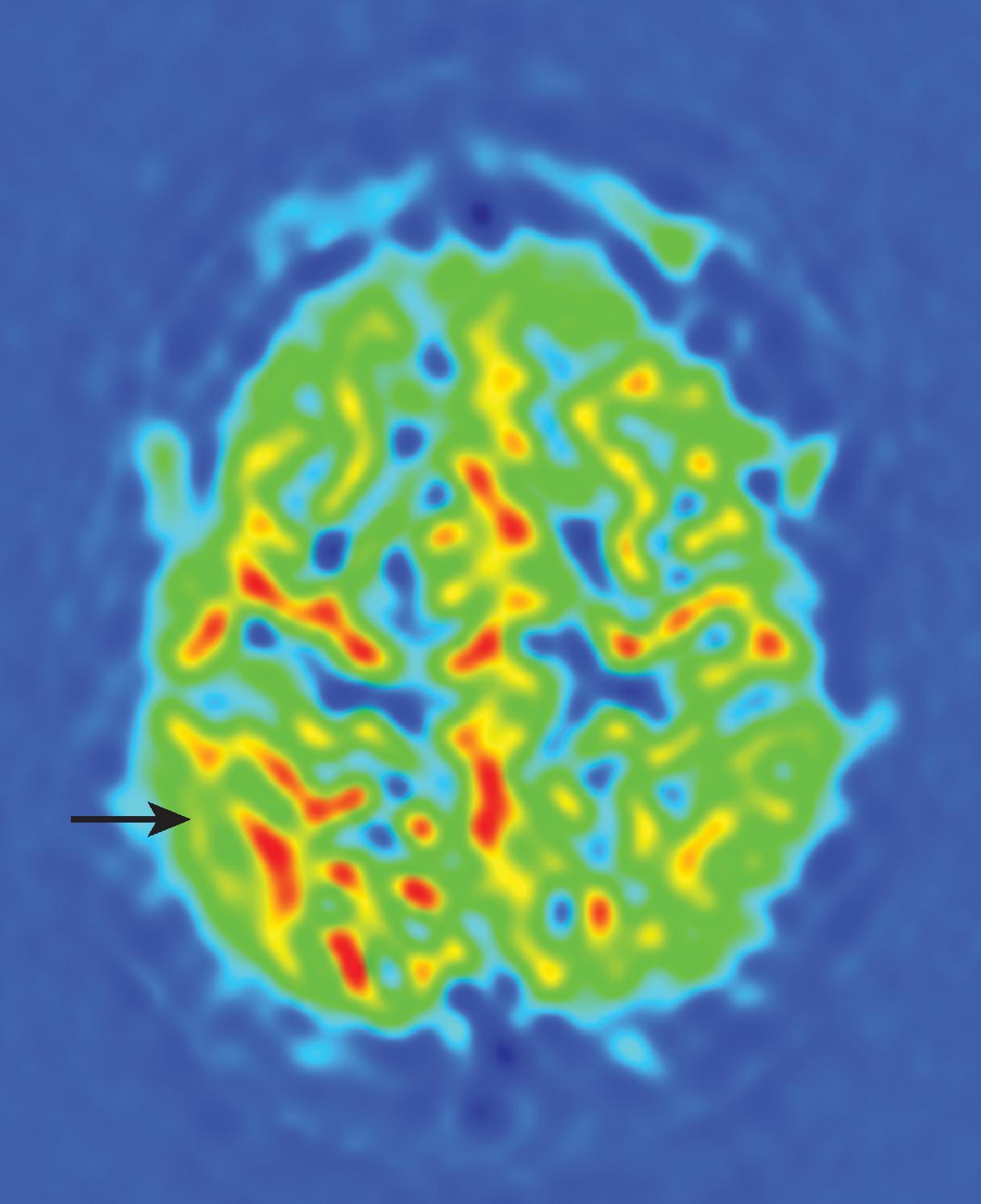 Altered Cerebral Blood Flow