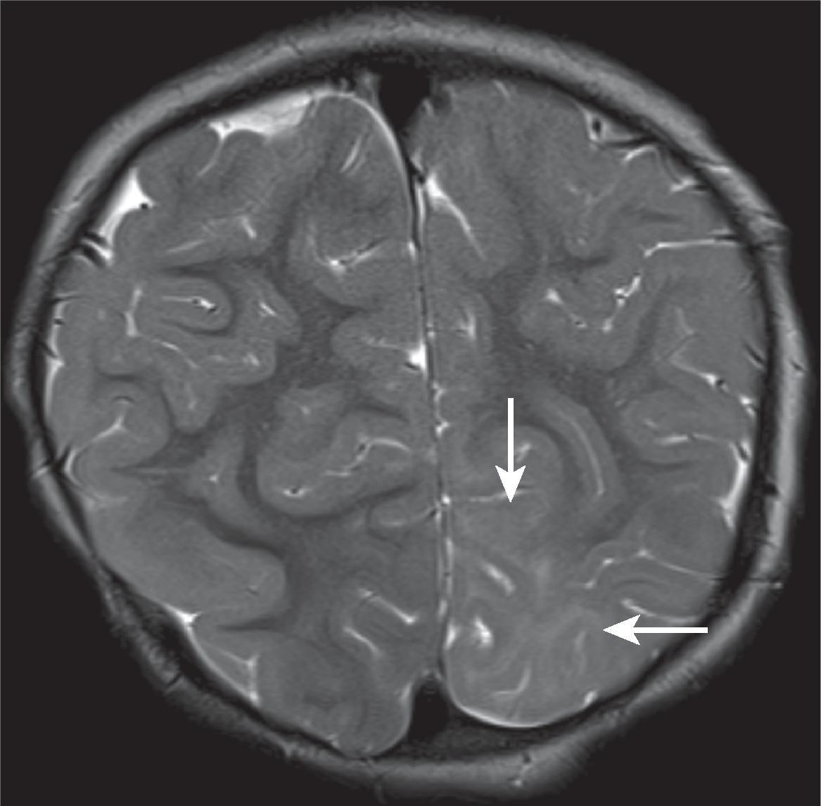 Juxtacortical T2/FLAIR Hyperintensity