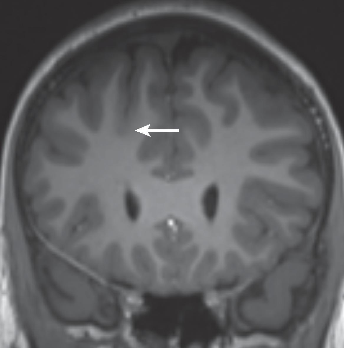 Blurring of Gray-White Matter Junction