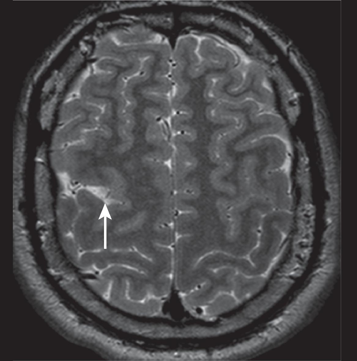 Abnormal Sulcation