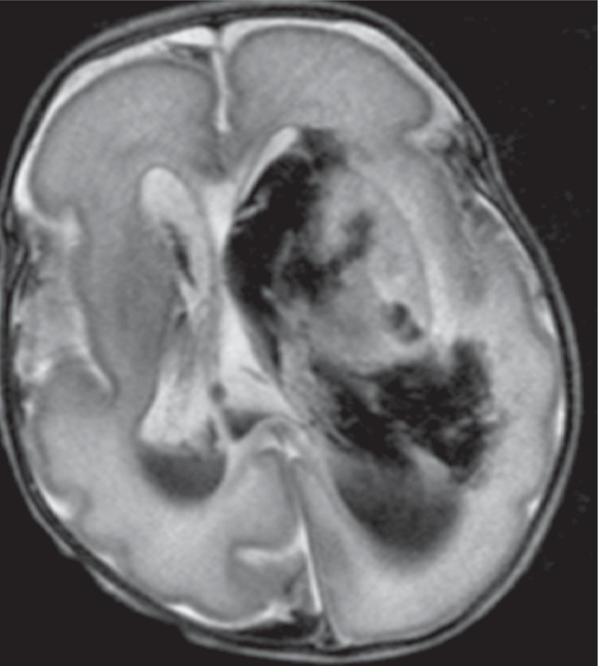 Germinal Matrix Hemorrhage