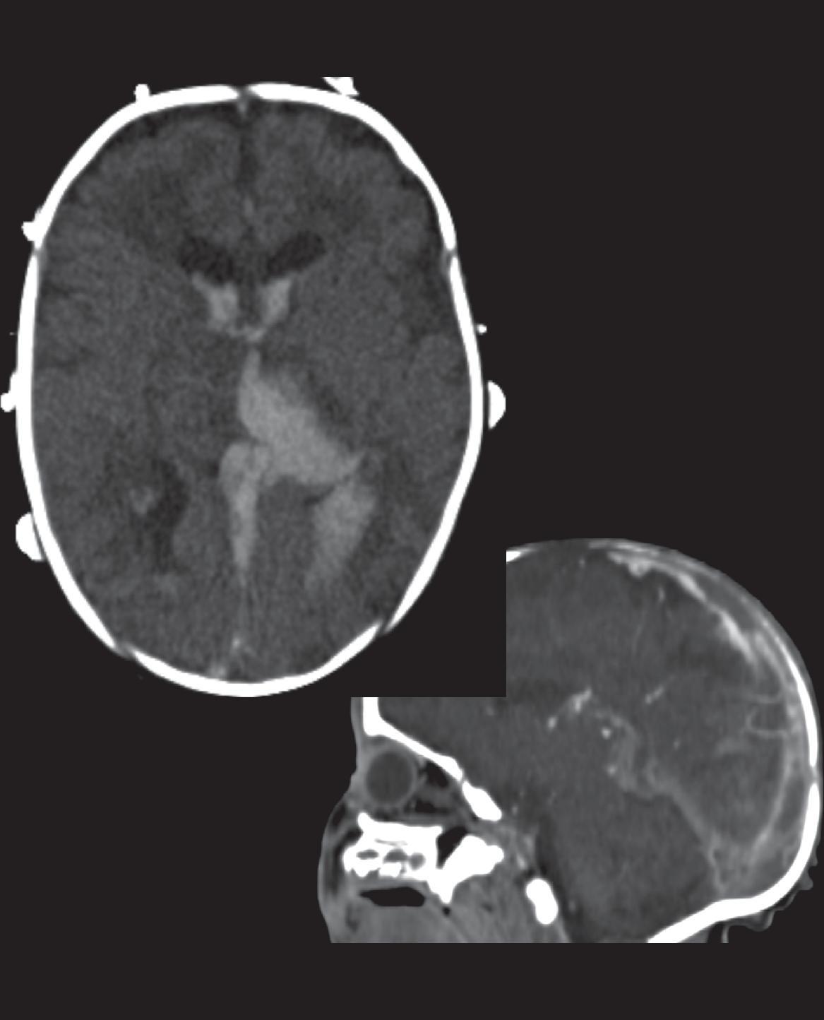 Venous Sinus Thrombosis