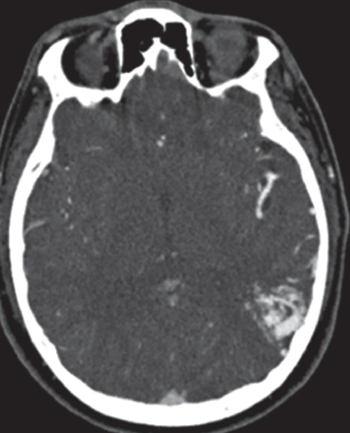 Vascular Malformation