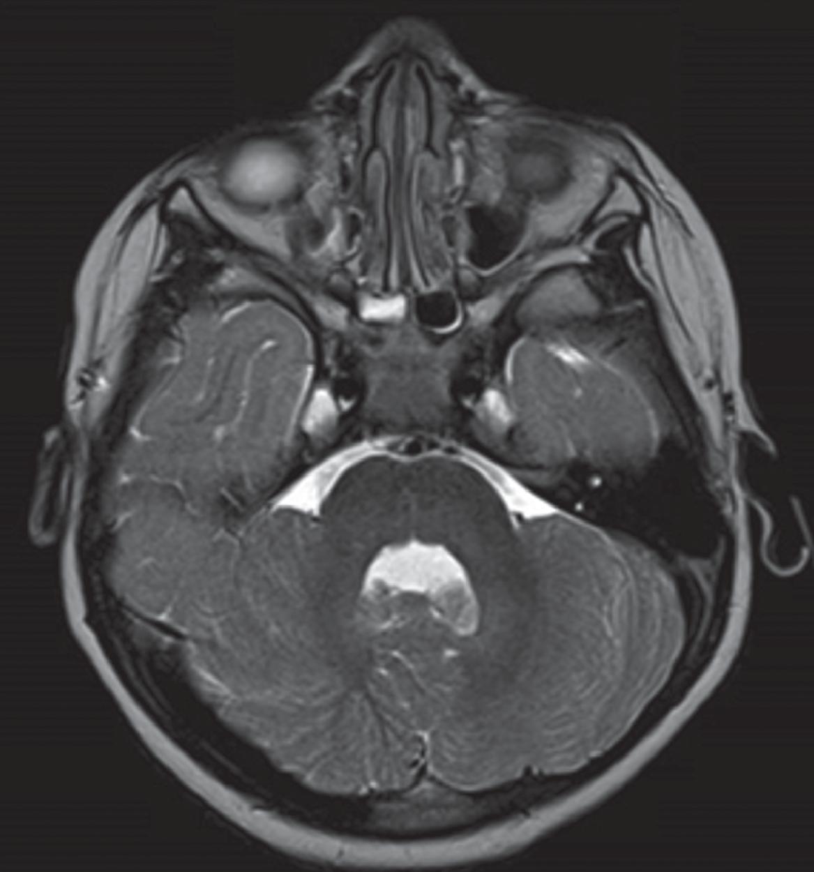 Unilateral Cerebellum Atrophy or Dysplasia