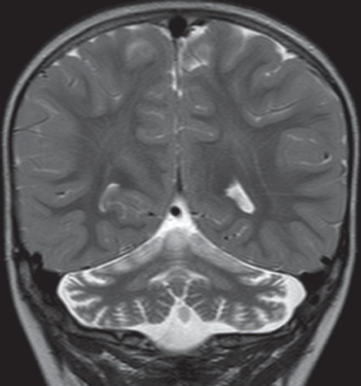 Bilateral Cerebellum with Progressive Atrophy