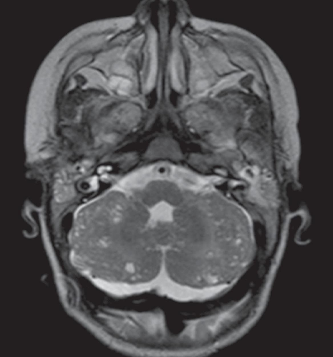 Bilateral Cerebellum with Cysts