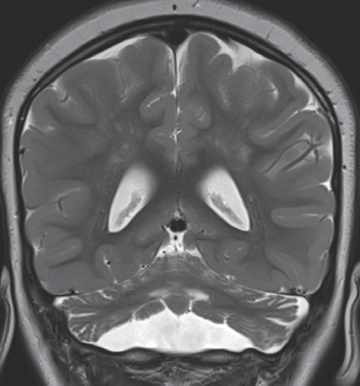 Bilateral Cerebellar Hypoplasia with Other Malformation