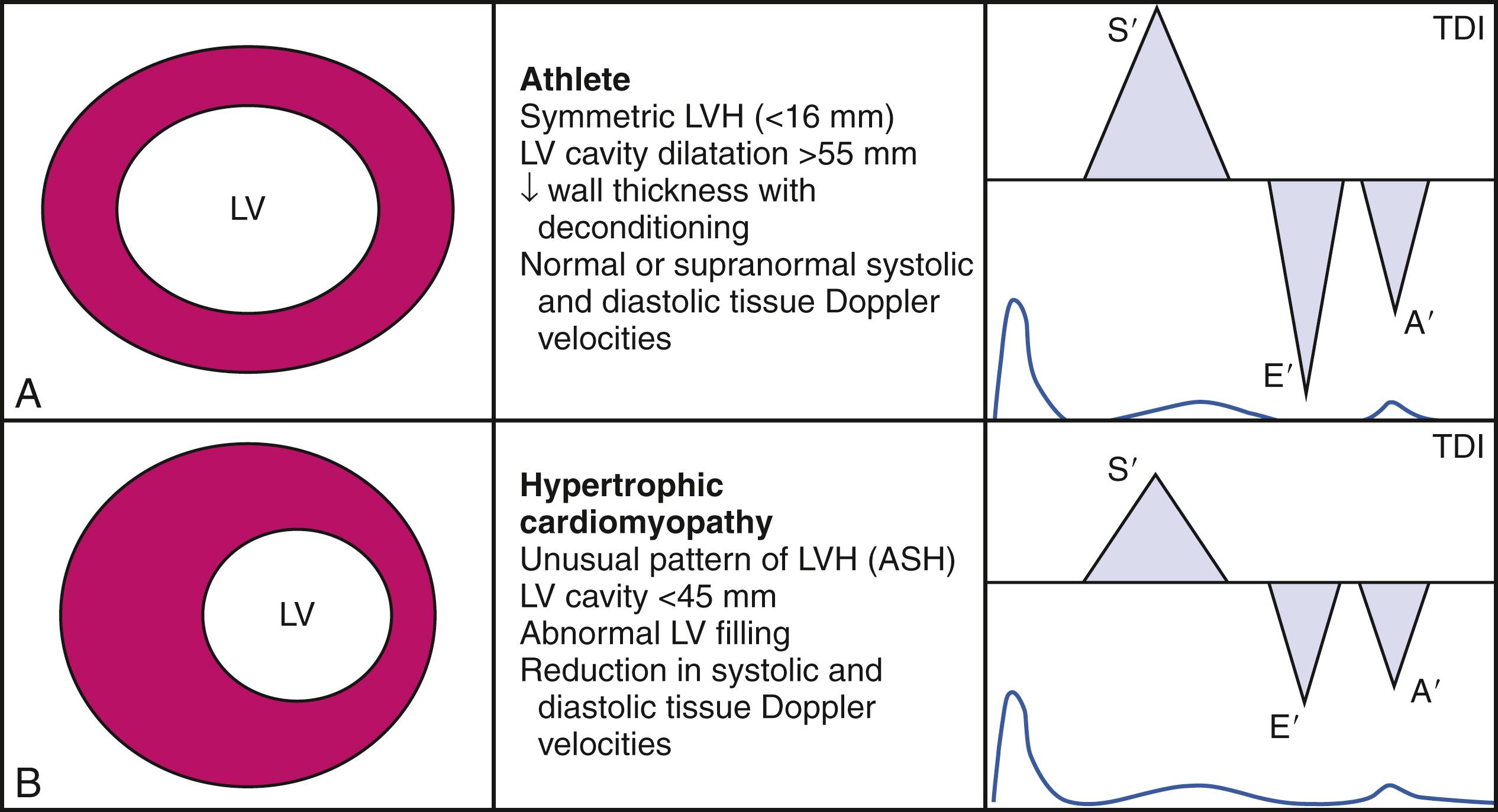 Figure 60.2, Characteristic features of left ventricular structure and function in an athlete’s heart (top row) compared with hypertrophic cardiomyopathy (bottom row). Schematic representation of tissue Doppler myocardial velocities (right), demonstrating the reduction in both systolic (S′) and diastolic (E′ and A′) myocardial annular velocities in a patient with hypertrophic cardiomyopathy, compared with normal or supranormal systolic and diastolic function in an athlete’s heart. ASH, Asymmetric septal hypertrophy; LV, left ventricular; LVH, left ventricular hypertrophy; TDI, tissue Doppler imaging.