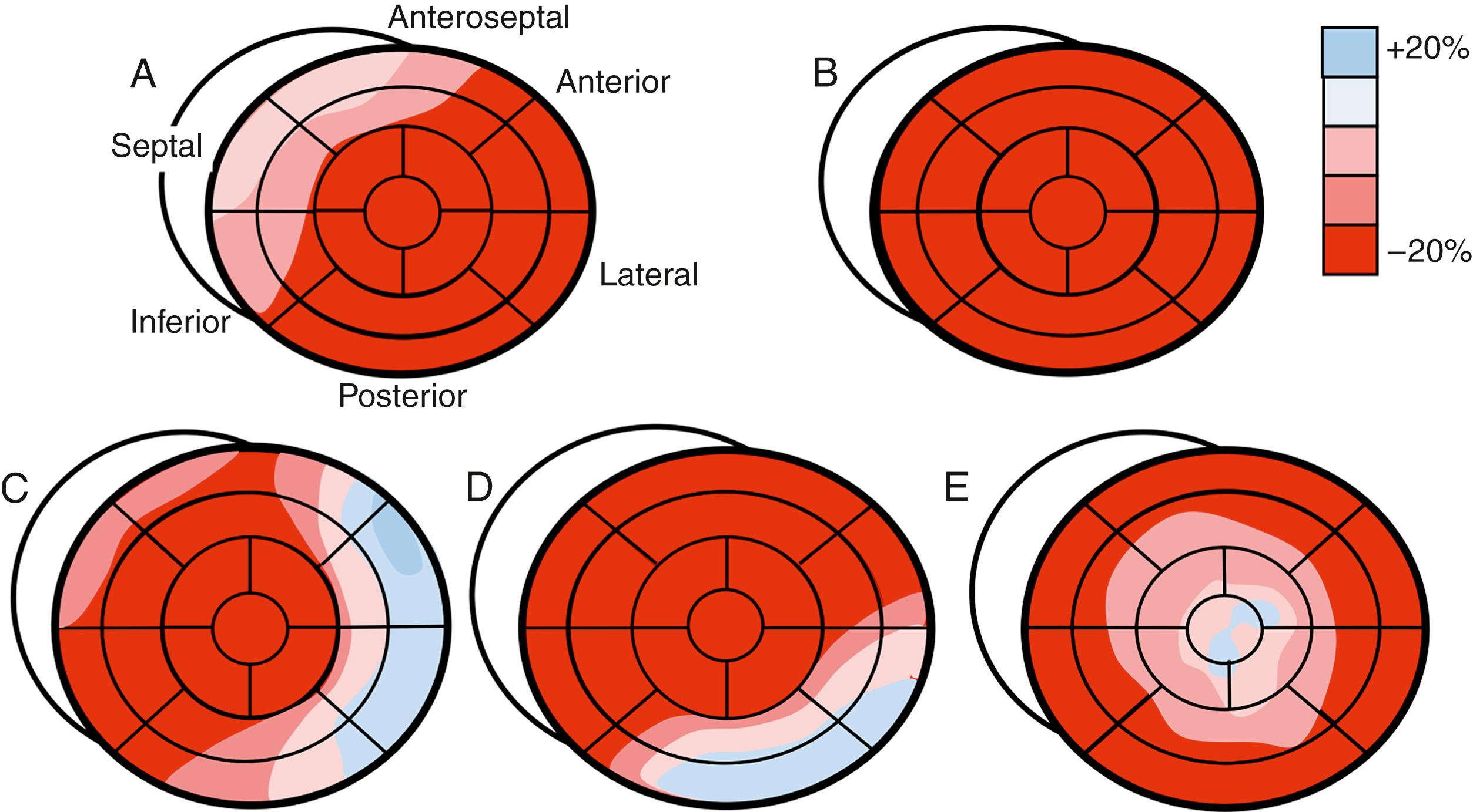 Figure 60.3, Representative peak systolic strain maps in various forms of left ventricular hypertrophy. A, A patient with hypertrophic cardiomyopathy and asymmetric septal hypertrophy demonstrating reduced strain in the basal and mid anteroseptal, septal, and inferior segments. B, An athlete with physiological hypertrophy, demonstrating normal strain values in all segments. C, A patient with cardiac amyloid, demonstrating reduced strain in the basal and midsegments, with relative apical sparing. D, A patient with Anderson-Fabry disease, demonstrating characteristic reduction in strain in the basal and mid inferolateral segments. E, A patient with left ventricular noncompaction cardiomyopathy demonstrating reduced strain in the mid and apical segments.