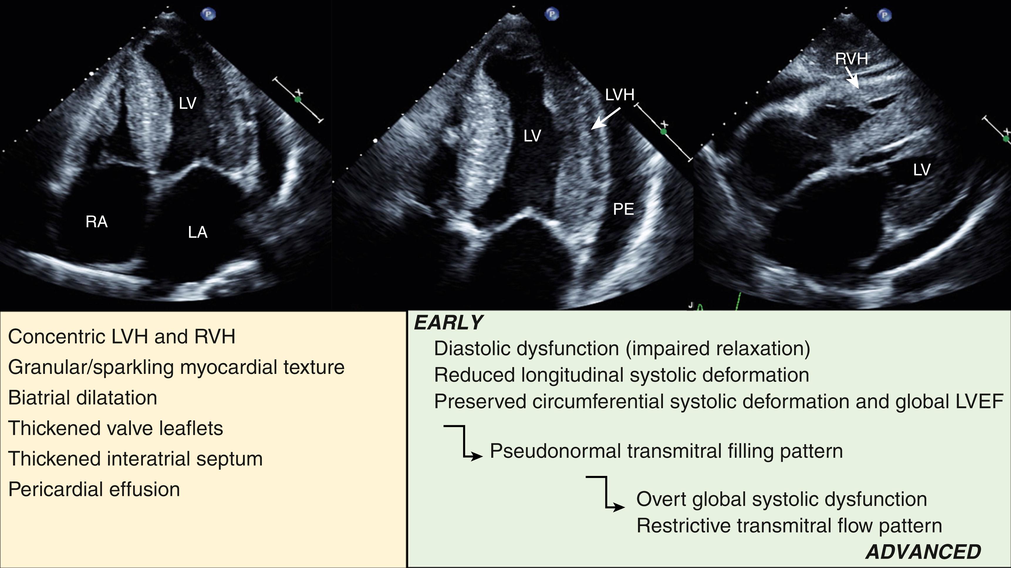 Figure 60.4, Typical echocardiographic features of cardiac amyloidosis. Transthoracic echocardiography demonstrating the classic features of cardiac amyloidosis. The progression of echocardiographic features from early to advanced disease is shown in the lower panel . LA, Left atrium; LV, left ventricle; LVEF, left ventricular ejection fraction; LVH, left ventricular hypertrophy; PE, pericardial effusion; RA, right atrium; RVH, right ventricular hypertrophy.