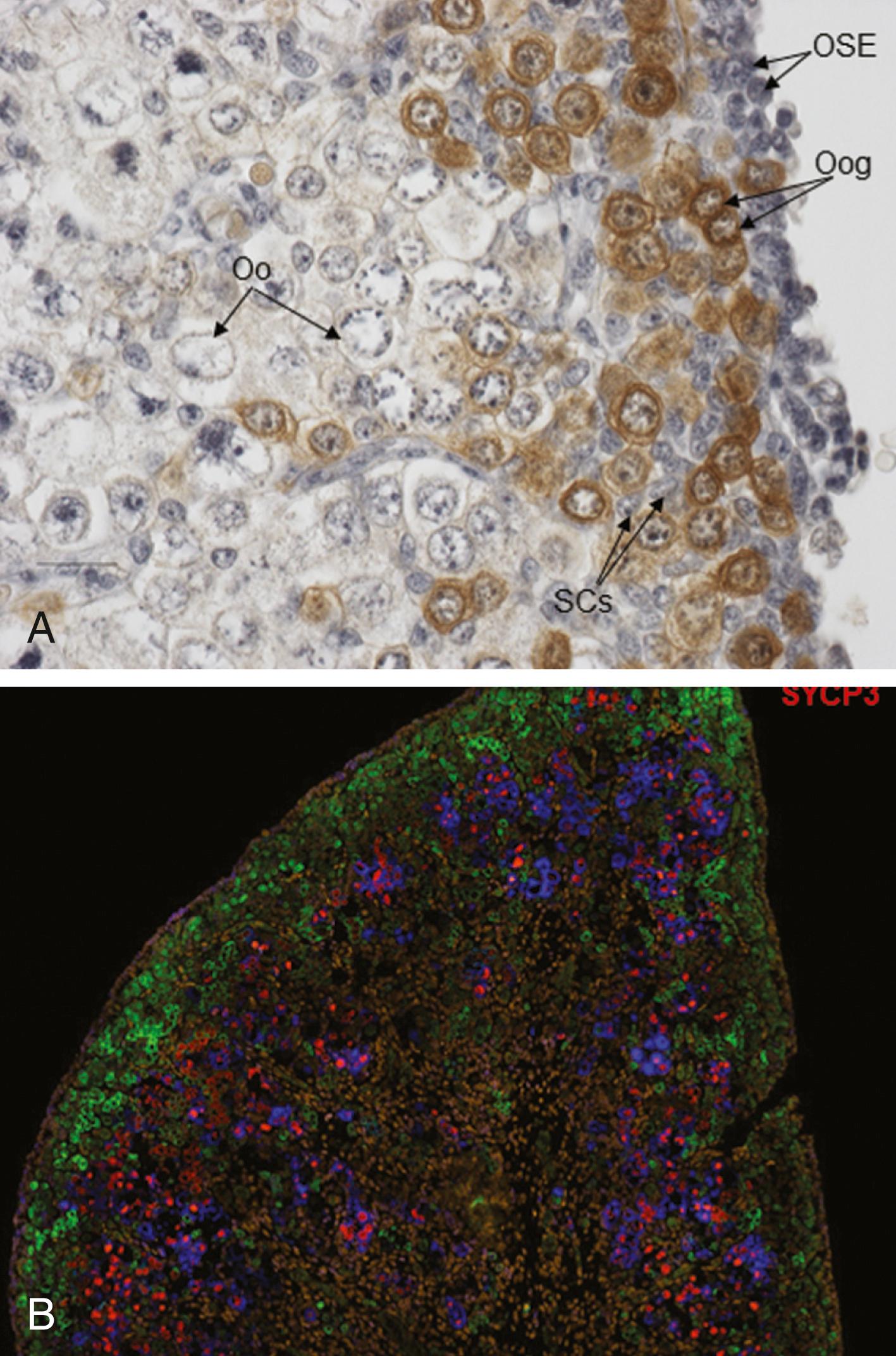 Fig. 147.2, Arrangement of germ cell populations in the human fetal ovary. (A) Photomicrograph of a section of 18 weeks gestation human fetal ovary, immunostained for the germline stem cell marker LIN28A (brown) . Small, mitotic, LIN28-expressing oogonia (oog) are located at the periphery of the ovary, under the ovarian surface epithelium (OSE) . As oogonia enter meiosis and become oocytes (Oo) , they move deeper into the ovary and extinguish LIN28A expression (note the characteristic meiotic chromatin arrangement in the nuclei of these cells (asterisks) ). Somatic cells (SCs) are interspersed between germ cells (see References 12 and 21 for further details). (B) Fluorescent micrograph of a section of 15 weeks gestation human fetal ovary, showing the radial arrangement of germ cell populations at different states of maturation. Pre- and early-meiotic oocytes expressing DAZL (green) are located towards the periphery of the ovary. Oocytes in mid- and late-meiotic prophase express BOLL and SYCP3, and are located more centrally, towards the ovarian medulla, where germ cell nest breakdown and primordial follicle formation occurs (see References 73 and 79 for further details).