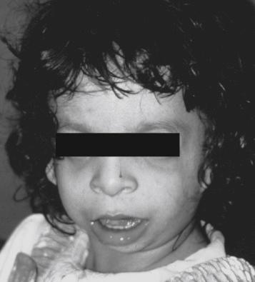 Fig. 188.1, Abnormalities pertinent to airway management in a patient with Treacher Collins syndrome (mandibulofacial dysostosis) include mandibular and malar hypoplasia, microstomia, and choanal atresia.