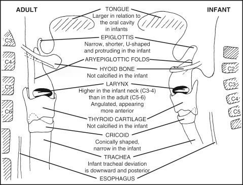 Fig. 188.2, Comparison of the anatomy in adult and infant airways.