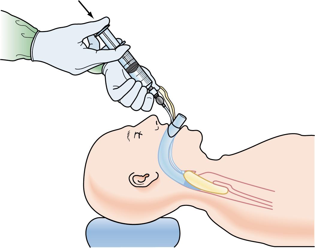 Fig. E1.11, Inflate the mask, without holding the tube or handle, with approximately 10–20 mL of airway to seal the airway. Apply a manual bag or anesthesia circuit and verify ventilation. If no ventilation (leak or resistance), assume misplacement of ILMA or down-folding of the epiglottis. Manipulate the ILMA in an up-and-down or in-and-out maneuver to optimize position. Recheck ventilation, and adjust location of the ILMA to optimize ventilation. Do not attempt to pass the endotracheal tube until effective ventilation is ensured.