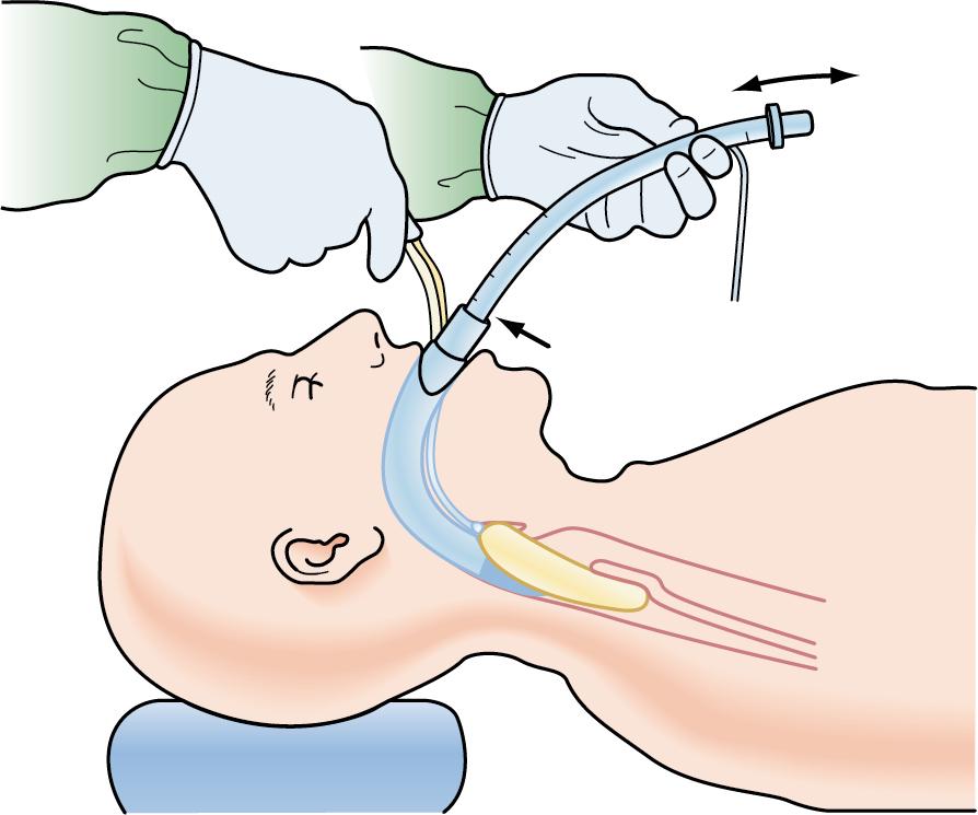 Fig. E1.12, Hold the ILMA handle while gently inserting the lubricated endotracheal tube (ETT) into the airway shaft. The provided ILMA-ETT is best suited for this, though a well-lubricated standard ETT may be used with fiber-optic guidance or may be used (with proper training and experience) blindly by inserting it “backward,” meaning the concave curve of the ETT faces the nose as it is advanced into the ILMA shaft.