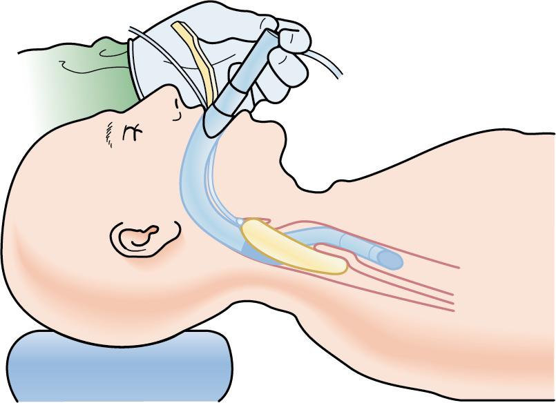 Fig. E1.13, Advance the ETT, inflate the cuff, and confirm intubation. If unable to pass, ensure adequate lubrication. If resistance is felt, the ILMA may be malpositioned or may have entrapped the epiglottis and thus block ETT advancement. Try the in-and-out maneuver to reposition the ILMA and free up the epiglottis if applicable.