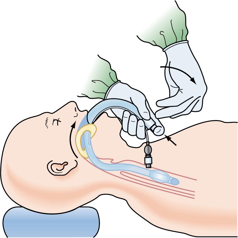 Fig. E1.14, Remove the ETT connector, and place the provided stabilizing rod onto the end of the ETT. Then ease the ILMA over the existing ETT and rod by gently swinging the handle caudally (keeping the ETT stable in position) until the ETT can be grasped at the level of the incisors.