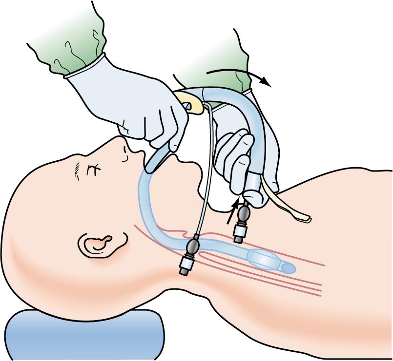 Fig. E1.15, Remove the stabilizing rod, and gently unthread the inflation line and pilot balloon of the ETT. Replace the ETT connector, and confirm ventilation and position per standard intubation procedures. If the ILMA has been used on a very challenging airway or the patient is unstable, delay removal of the ILMA from the existing ETT until stabilization takes place. Extubation of the airway is possible, so this maneuver should only be performed by those skilled in its execution.