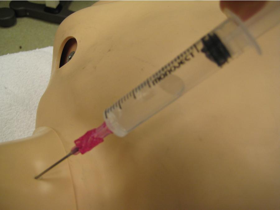 Fig. E1.18, Puncture of cricothyroid membrane, with air aspiration reflected in bubbling in saline-filled syringe.