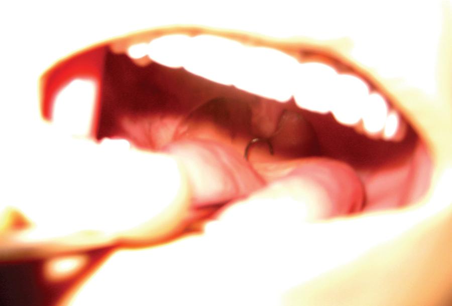 Fig. E1.19, Locating and retrieving the retrograde wire within the oral cavity.