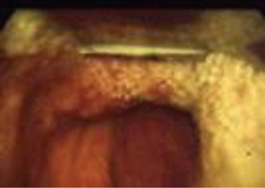 Fig. E1.5, A grade IV view, essentially no view at all of the laryngeal structures. The bougie is not indicated for a grade IV view, though in experts’ hands and after failure of other techniques, careful blind passage combined with detection of tip hang-up (carina, mainstem bronchus) may allow blinded intubation. This is a last-ditch effort maneuver and is not recommended as a routine approach. It is best handled with an SGA, flexible fiber-optic bronchoscopy (FFB), or video-assisted laryngoscopy (VAL).