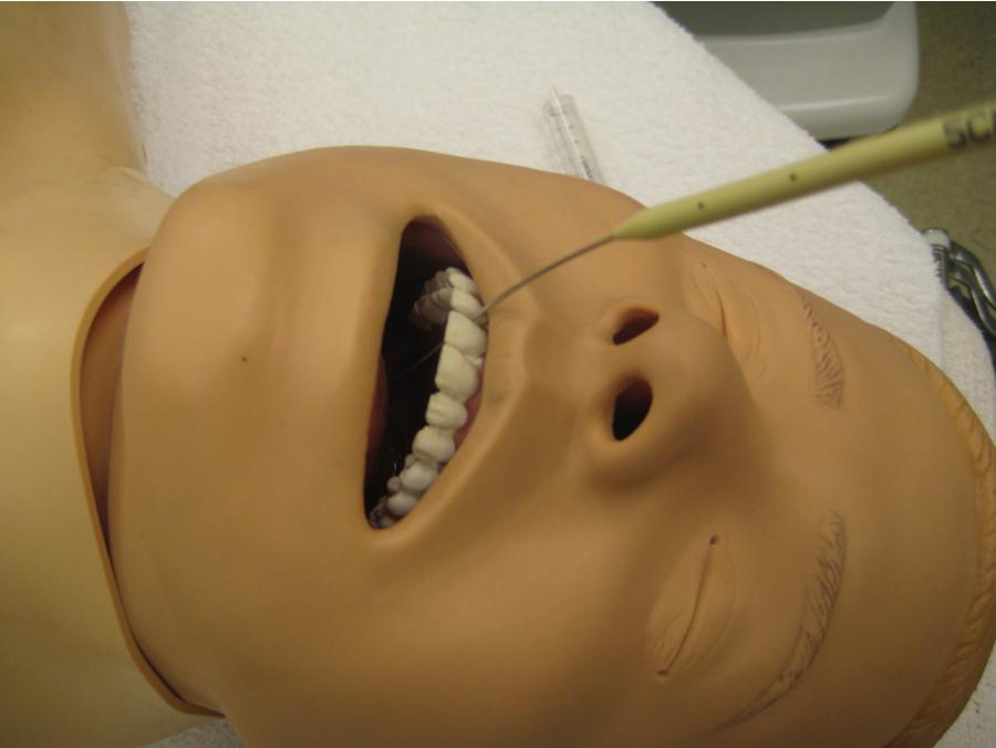 Fig. E1.21, Passing the Cook obturator over the retrograde wire to reinforce the wire to allow ease of passing the ETT into the airway.