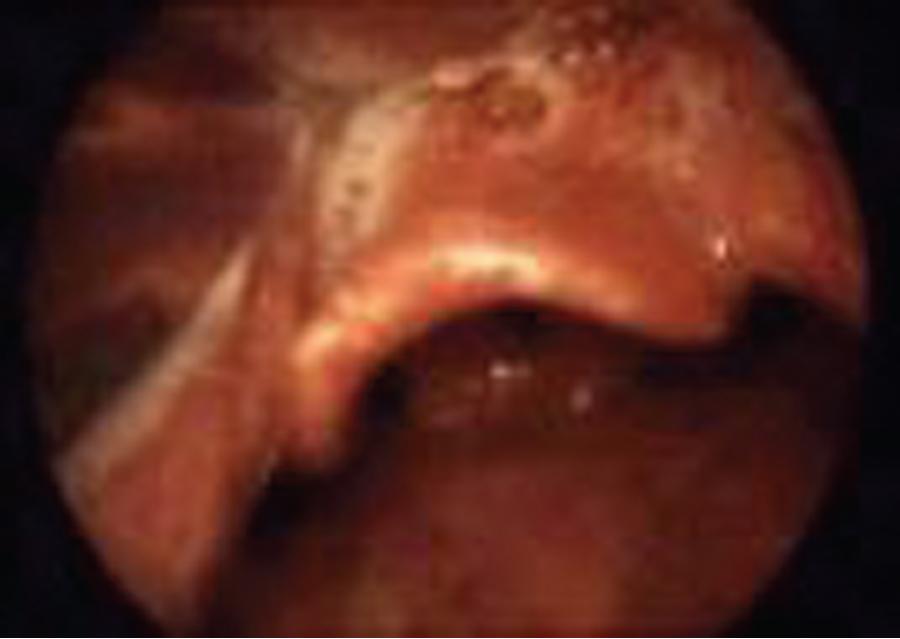 Fig. E1.3, Cook-Yentis grade IIb laryngeal view with direct laryngoscopy achieves a very high success rate with bougie-assisted intubation.