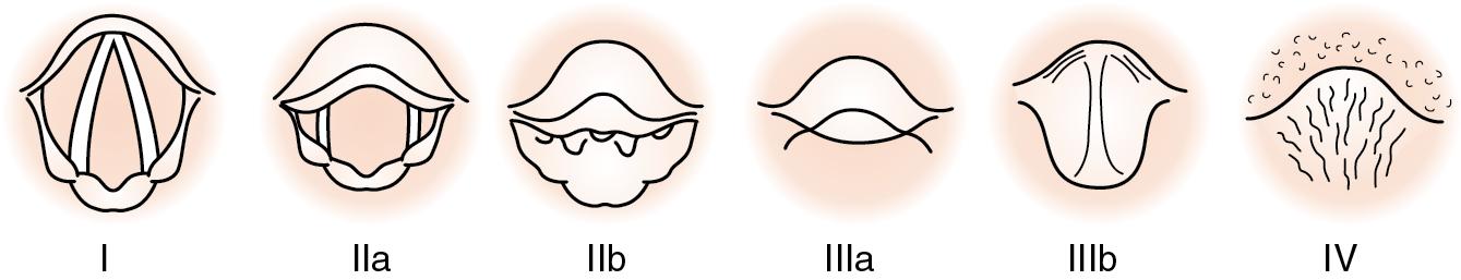 Fig. E1.2, Lehane-Cormack laryngeal view grading system with the Cook-Yentis modifications, grades I → IV.