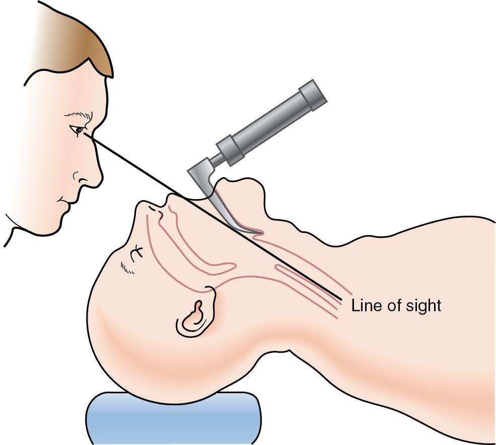 Fig. E1.1, Line of sight with direct laryngoscopy.