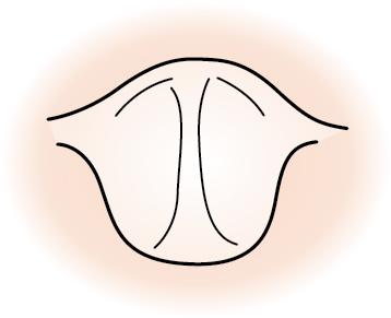 Fig. E1.7, A grade IIIb view; floppy or overhanging epiglottis may be difficult to navigate around with a variety of airway adjuncts. The bougie may be used to elevate the epiglottis and navigate into the trachea, but the success rate is substantially lower in the grade IIIb setting (30%–50%) compared with a grade IIIa (only leading edge of epiglottis visible, 80%–90%).