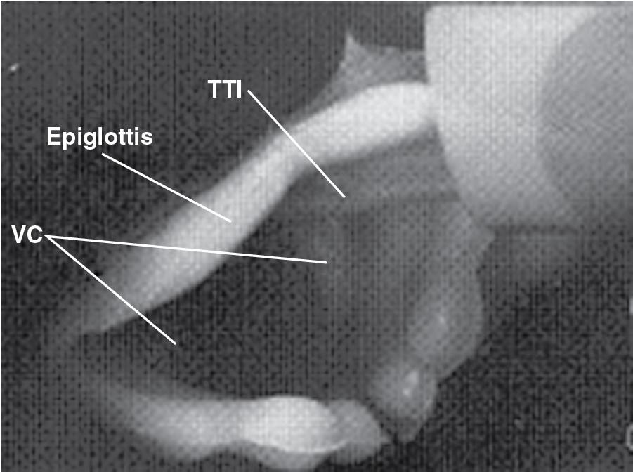 Fig. E1.8, Endotracheal tube (ETT) being passed over tracheal tube introducer (TTI, bougie) and getting hung up on the epiglottis and arytenoid. Continued advancement should be discouraged. Simply withdraw 1–2 cm, rotate ETT counterclockwise about 90 degrees, and readvance. VC, Vocal cord.