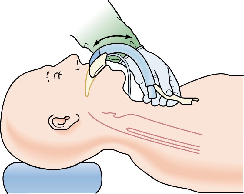 Fig. E1.9, Deflate the cuff, and lubricate with a water-soluble lubricant on the posterior surface. The lubricated intubating laryngeal mask airway is passed over the hard to soft palate along the posterior pharyngeal wall to the point where gentle resistance is felt.