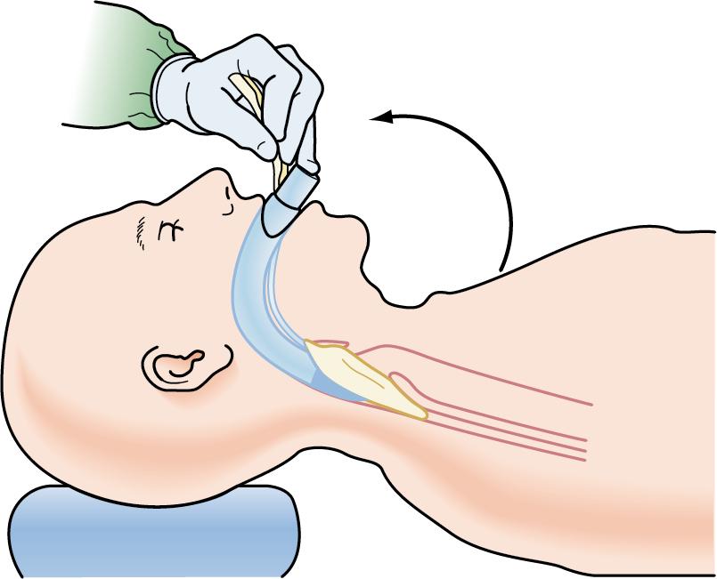 Fig. E1.10, Swing the mask into place in a circular movement, maintaining contact against the palate and posterior wall of the pharynx. Do not use the handle as a lever.