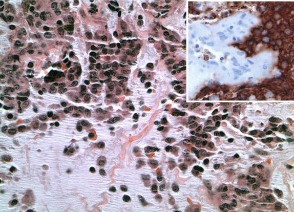 FIG. 8.3, Myxoid variant of diffuse large B-cell lymphoma. The lymphoma cells have vesicular chromatin and moderate amounts of eosinophilic cytoplasm. The inset shows the CD20 immunostain, confirming a B-cell lineage.
