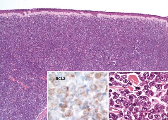 FIG. 8.9, Primary cutaneous diffuse large B-cell lymphoma, leg type. Low magnification shows a diffuse infiltrate of atypical large cells that express CD20. The inset in the lower right corner shows a predominance of large, round immunoblastic cells. Expression of BCL2 is characteristic.