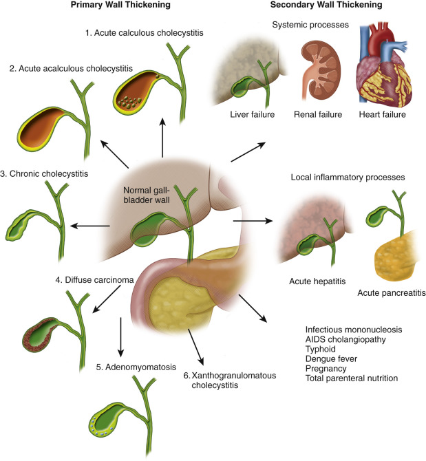 Figure 56-1, The various causes of diffuse gallbladder wall thickening. AIDS, Acquired immunodeficiency syndrome.