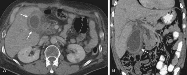 Figure 56-2, Acute calculus cholecystitis. Axial (A) and coronal (B) contrast-enhanced computed tomography images in a febrile 45-year-old woman with right upper quadrant abdominal pain show diffuse wall thickening and enhancement with marked distention of the gallbladder ( arrows, A ). Associated pericholecystic stranding is also seen with mild wall thickening of the adjacent transverse colon on the coronal image (arrow).