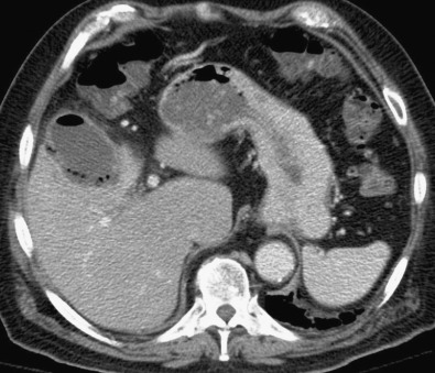 Figure 56-4, Emphysematous cholecystitis. Axial contrast-enhanced CT scan of the abdomen in a 48-year-old patient with diabetes shows multiple pockets of intramural gas and an intraluminal air/fluid level. Mild pericholecystic fat stranding is seen.