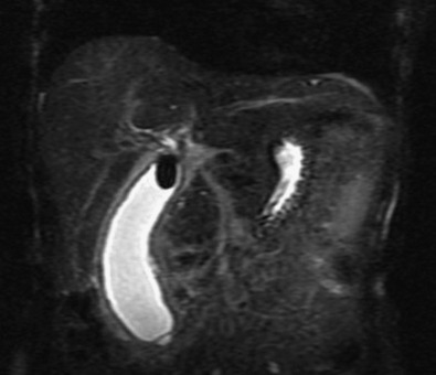 Figure 56-5, Acute calculus cholecystitis. Coronal fat-suppressed T2-weighted magnetic resonance image in a 47-year-old woman shows distended gallbladder with diffuse wall thickening and a rounded low signal intensity calculus seen lodged at the gallbladder neck.