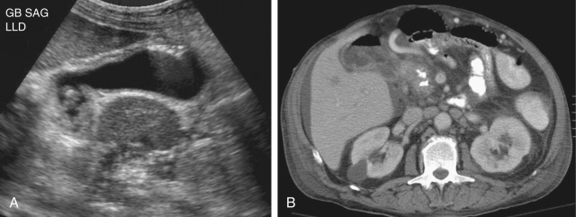 Figure 56-6, Acute calculus cholecystitis with emphysematous change. A, Sagittal ultrasound image of the abdomen in a 42-year-old man with right upper quadrant pain shows a distended gallbladder with wall thickening and a calculus seen at the gallbladder neck. Multiple tiny echogenic reflectors corresponding to gas bubbles are seen along the antidependent portion of the gallbladder wall with “comet tail” artifact. B, Axial contrast-enhanced computed tomography scan confirmed the presence of gas within the gallbladder. Significant fat stranding and fluid collections are seen in the pericholecystic region. GB, Gallbladder; SAG, sagittal.