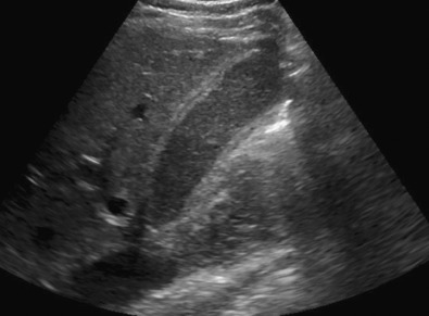 Figure 56-7, Acute acalculus cholecystitis. Sagittal ultrasound image in a 45-year-old woman with sepsis shows distended gallbladder filled with echogenic sludge and diffuse wall thickening. No calculus was identified on the scan.