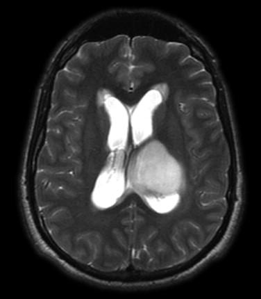 Fig 2, Diffuse astrocytoma. T2-weighted MRI showing bright signal of the tumor.