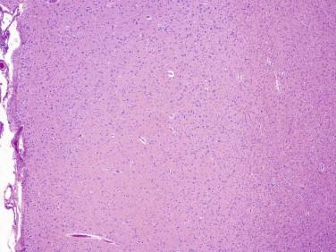 Fig 4, Diffuse astrocytoma. Low-magnification section showing diffusely increased cellularity of the gray ( left ) and white ( right ) matter.