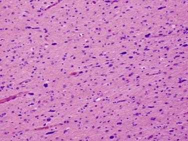 Fig 5, Diffuse astrocytoma. Infiltrating tumor cells show mild nuclear pleomorphism and poorly defined cell borders.