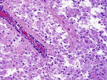 Fig 7, Gemistocytic astrocytoma. Tumor cells have plump homogeneous eosinophilic cytoplasm. A perivascular lymphoid infiltrate is also seen.