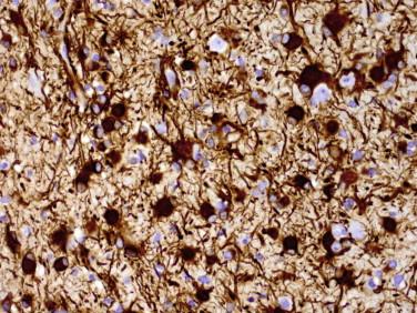 Fig 8, Gemistocytic astrocytoma. Strong cytoplasmic immunoreactivity for GFAP is typical.