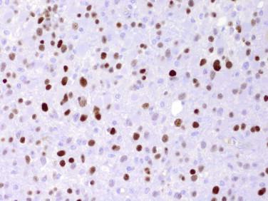 Fig 9, Diffuse astrocytoma. Immunohistochemistry for TP53 showing strong nuclear reactivity in many tumor cells.